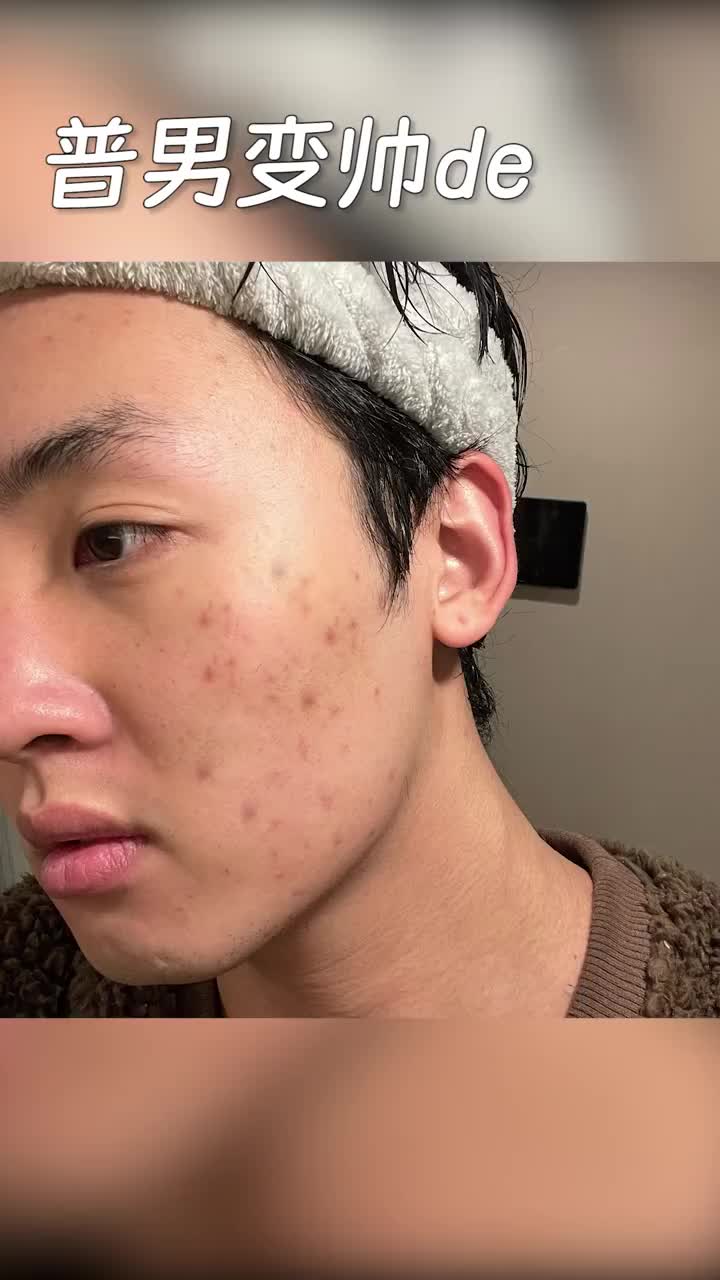 中国人不骗中国人！痘龄3年！真诚去痘好物