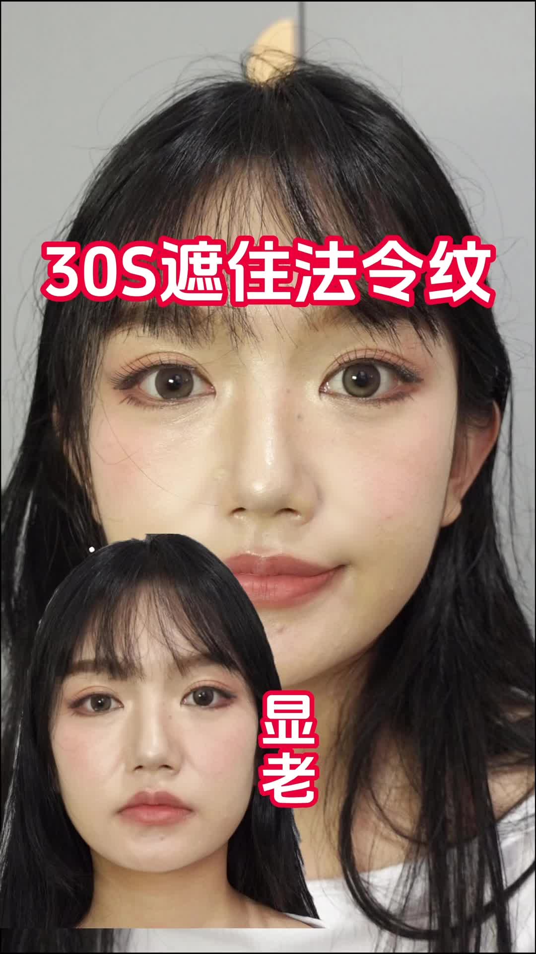 30S遮凹陷导致的法令纹