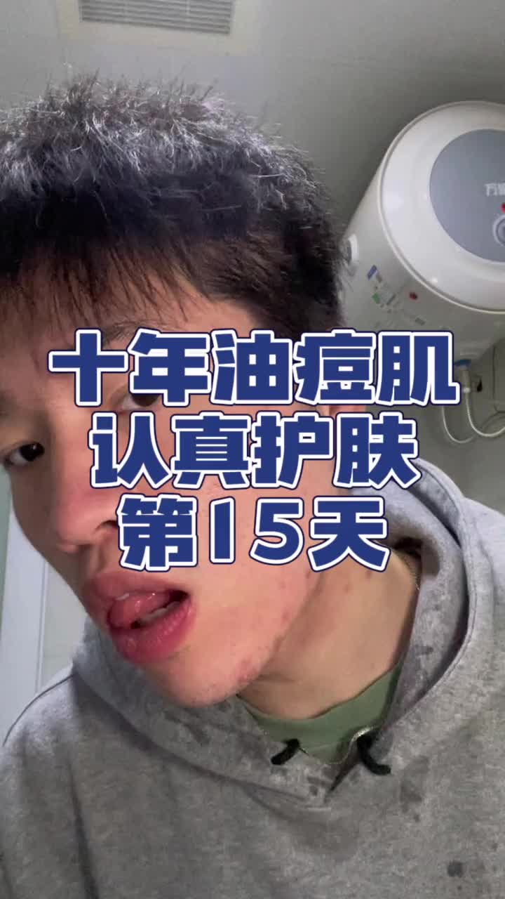 油痘肌，好好护肤！第15天！！