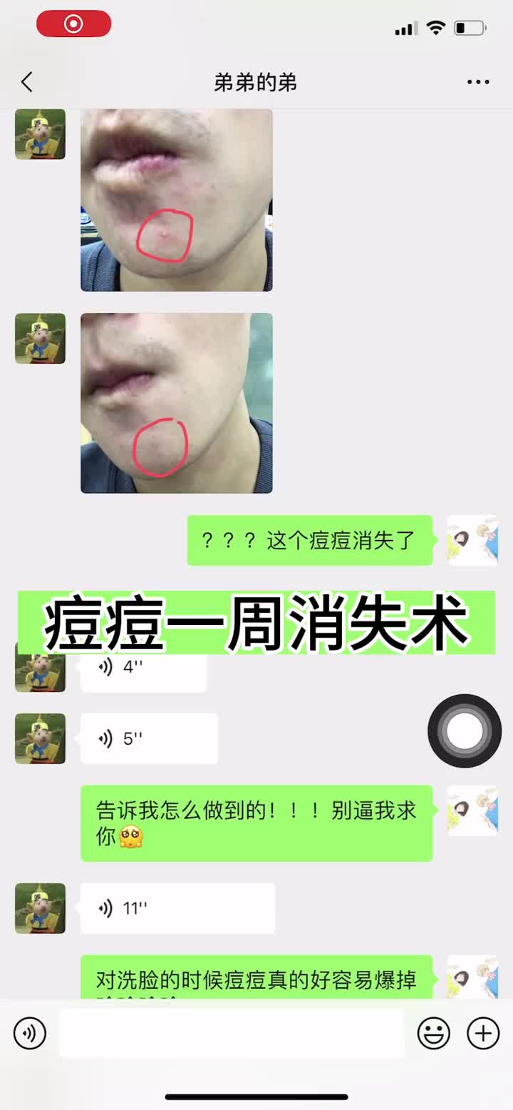 两个小东西 搞定一整个夏天的痘痘😽
