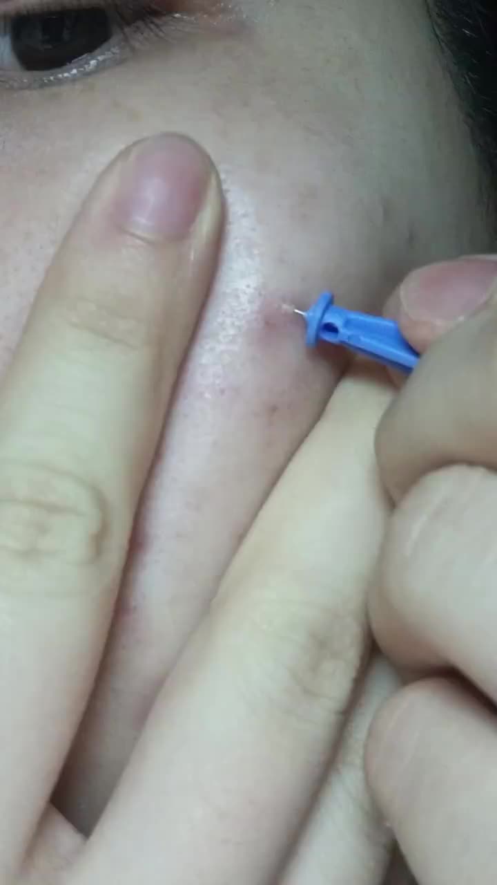 看别人挤痘哪有自己挤痘爽～